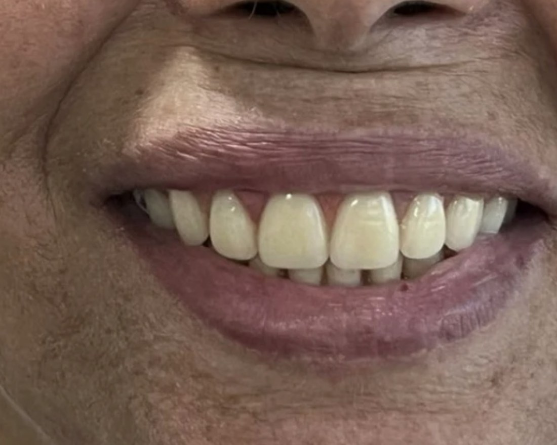 Depois do tratamento